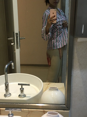 武漢同濟馮幼平水動力吸脂瘦大腿前后對比照片~真實案例圖分享