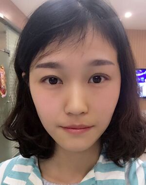 韓式微創(chuàng)雙眼皮恢復(fù)圖，超自然微創(chuàng)跡