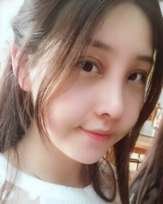 全切雙眼皮+開(kāi)眼角前后對(duì)比照片圖