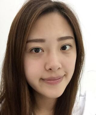 高強(qiáng)度聚焦超聲美容前后對(duì)比圖照片，高強(qiáng)度聚焦超聲適合皮膚輕度松弛患者