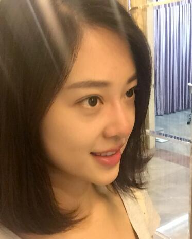 高強(qiáng)度聚焦超聲美容前后對(duì)比圖照片，高強(qiáng)度聚焦超聲適合皮膚輕度松弛患者