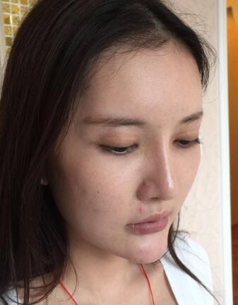 這是我做埋埋蛋白線.提升前拍的照片，看得出來(lái)面部肌膚走向下垂，皮膚松弛了