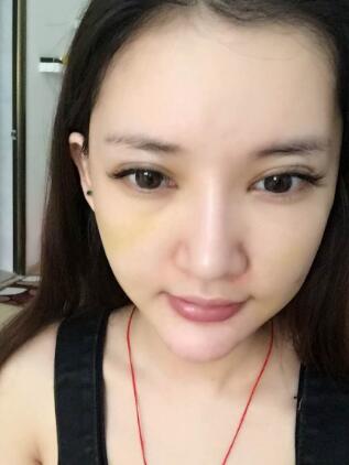 面部面b提升恢復(fù)日記和恢復(fù)圖片，一周左右恢復(fù)自然