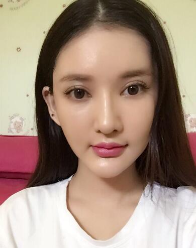 面部面b提升恢復(fù)日記和恢復(fù)圖片，一周左右恢復(fù)自然