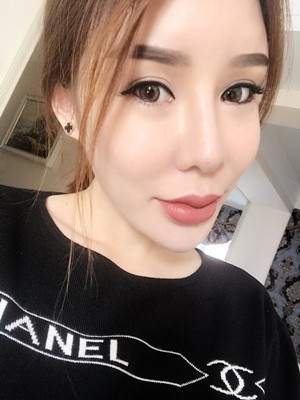 高強(qiáng)度聚焦超聲手術(shù)三個(gè)月的前后恢復(fù)記錄——海口紅妝李科做的