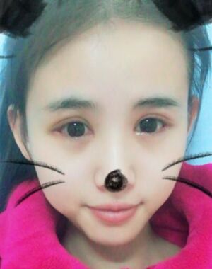 三點(diǎn)定位雙眼皮恢復(fù)實(shí)例，張永義做的