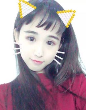 三點(diǎn)定位雙眼皮恢復(fù)實(shí)例，張永義做的