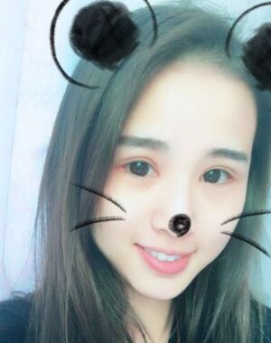 三點(diǎn)定位雙眼皮恢復(fù)實(shí)例，張永義做的