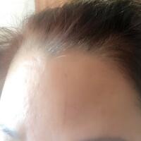 去抬頭紋很好的方法是注射注射瘦臉，恢復過程圖分享