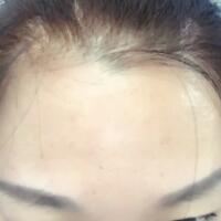 去抬頭紋很好的方法是注射注射瘦臉，恢復過程圖分享