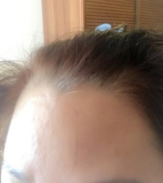 去抬頭紋很好的方法是注射注射瘦臉