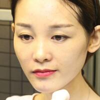 玻尿酸豐太陽穴對比照片和恢復過程分享