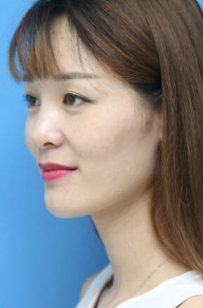 玻尿酸豐太陽穴對(duì)比照片和恢復(fù)過程分享