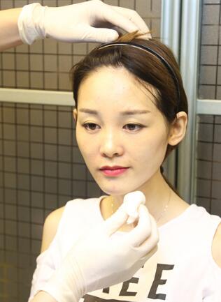 玻尿酸豐太陽穴對(duì)比照片和恢復(fù)過程分享