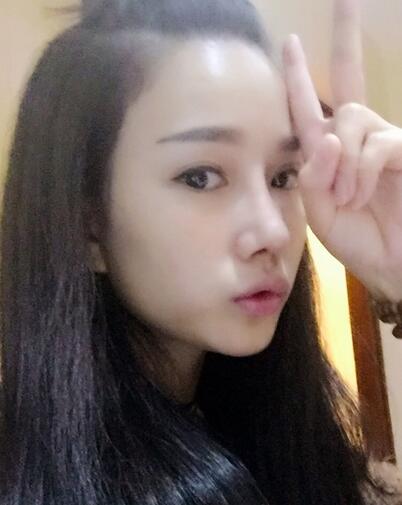 隆鼻整形真實(shí)恢經(jīng)歷 曬圖啦！