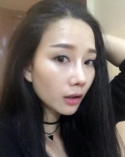 隆鼻整形真實(shí)恢經(jīng)歷 曬圖啦！