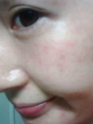 激光去雀斑果好不好，真實案例告訴你