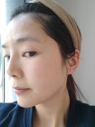 做完光子嫩膚恢復(fù)圖片和過程分享,光子嫩膚價格3800元