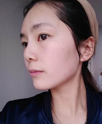 做完光子嫩膚恢復(fù)圖片和過程分享,光子嫩膚價格3800元