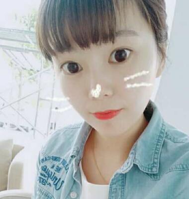 做完光子嫩膚恢復(fù)圖片和過程分享,光子嫩膚價格3800元