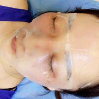 有誰做過激光祛雀斑？個人激光祛雀斑后恢復日記分享