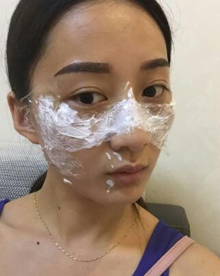 有誰(shuí)做過(guò)激光祛雀斑？個(gè)人激光祛雀斑后恢復(fù)日記分享