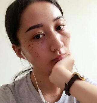 有誰(shuí)做過(guò)激光祛雀斑？個(gè)人激光祛雀斑后恢復(fù)日記分享