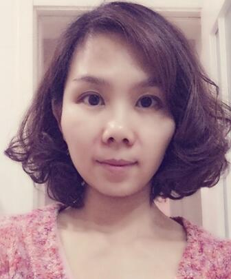 玻尿酸去法令紋后人變年輕了好幾歲