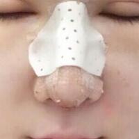 隆鼻失敗修復后恢復圖分享，鼻子修復價格9800元