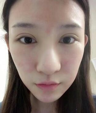 隆鼻失敗修復(fù)后恢復(fù)圖分享，鼻子修復(fù)價(jià)格9800元