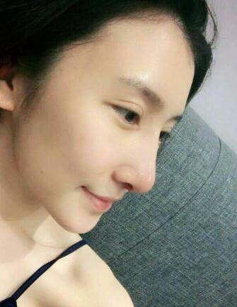 隆鼻失敗修復(fù)后恢復(fù)圖分享，鼻子修復(fù)價(jià)格9800元