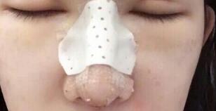 隆鼻失敗修復(fù)后恢復(fù)圖分享，鼻子修復(fù)價(jià)格9800元