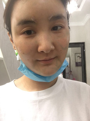 邯鄲雅乾侯德勝自體脂肪豐蘋果肌真實案例：附上前后對比圖片~