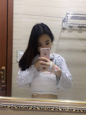 自體脂肪隆胸手術真實案例——邯鄲雅乾侯德勝醫(yī)生做的