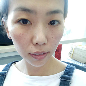 激光祛曬斑真實案例分享，并附上前后對比圖片