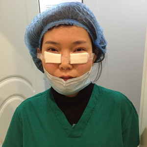 激光祛眼袋手術(shù)真實案例——邯鄲雅乾劉紅艷醫(yī)生做的