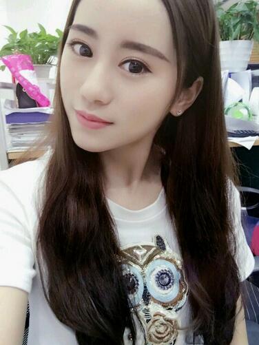 割雙眼皮案例圖片 雙眼皮手術(shù)20天