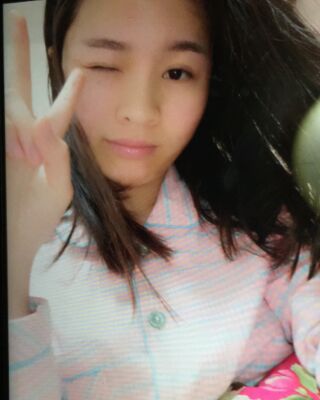 激光祛痘三次對比圖，痘痘全消除了