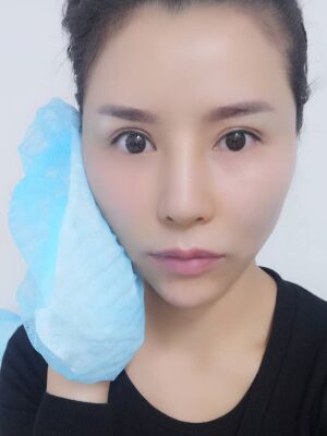 臉部埋埋蛋白線.提升果圖，真實(shí)經(jīng)歷分享