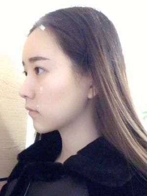 自體脂肪詳細(xì)部填充日記，恢復(fù)過程分享