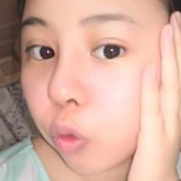 鼻部綜合整形恢復過程圖分享