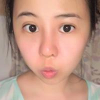 鼻部綜合整形恢復過程圖分享