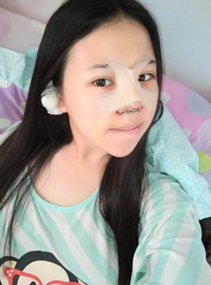 鼻部綜合整形恢復(fù)過程圖分享