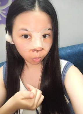 鼻部綜合整形恢復(fù)過程圖分享