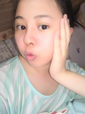 鼻部綜合整形恢復(fù)過程圖分享