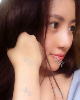 福州愛(ài)美爾假體隆鼻失敗后成功修復(fù)果圖