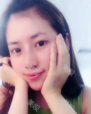 福州愛(ài)美爾假體隆鼻失敗后成功修復(fù)果圖