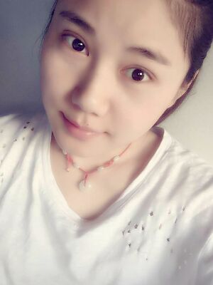 福州愛美爾切開雙眼皮消腫過程圖分享