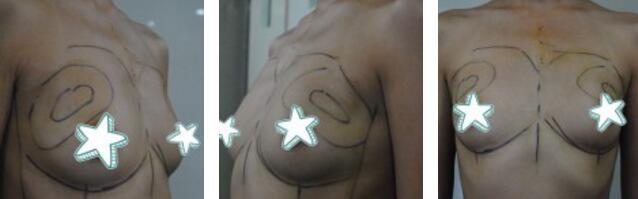 自體脂肪移植隆胸果圖分享，吸脂隆胸價格18800元