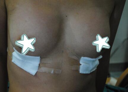 自體脂肪移植隆胸果圖分享，吸脂隆胸價格18800元